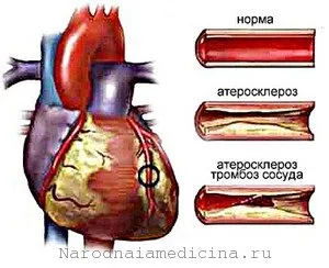 кардіосклероз серця