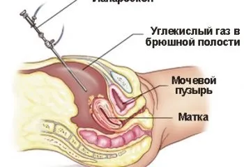 Кіста гортані симптоми, фото і лікування (кіста) Кіста гортані симптоми, фото і лікування
