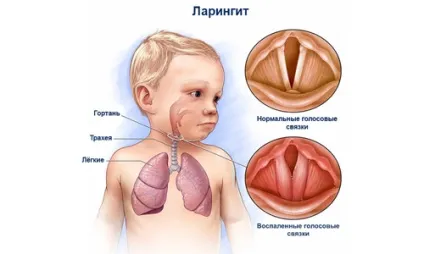 Кашель у дитини 10 місяців ніж лікувати краще і безпечніше (дитини місяців лікувати) Кашель у дитини 10 місяців ніж лікувати краще і безпечніше