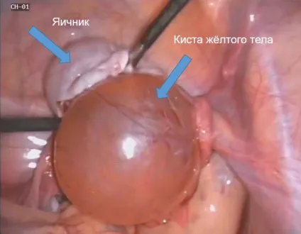 Кіста лівого яєчника який буває, чому і як виявляється