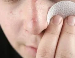 Кому потрібен крем для обличчя з азелаїнової кислотою
