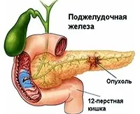 Лікувальне голодування при панкреатиті можна голодувати, як вийти з голодування (голодування) Лікувальне голодування при панкреатиті можна голодувати, як вийти з голодування