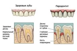 Лікування пародонтиту в домашніх умовах (умовах) Лікування пародонтиту в домашніх умовах
