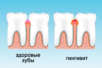 Ларингіт у дітей - причини і профілактика дитини