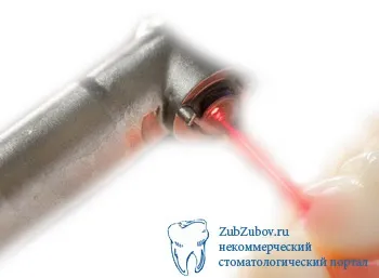 Лікування карієсу лазером без свердління і болю, а також icon і озоном