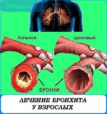 Лікування бронхіту у дорослих