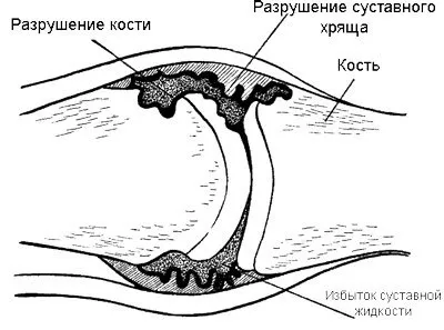 Лікувальна гімнастика при загостренні артриту - справа рук хворого (загостренні) Лікувальна гімнастика при загостренні артриту - справа рук хворого