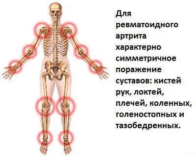 Лікувальна гімнастика при загостренні артриту - справа рук хворого (вдиху поволі піднімати) Лікувальна гімнастика при загостренні артриту - справа рук хворого