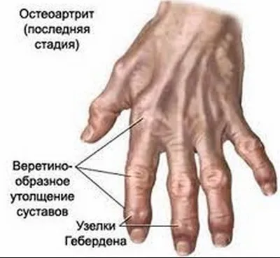 Лікування суглобів пальців рук і профілактика хвороби (кисть) Лікування суглобів пальців рук і профілактика хвороби
