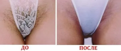 Лазерна епіляція бікіні як підготуватися до процедури, відгуки