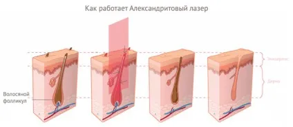 Лазерна епіляція олександритовим лазером ціна, відгуки