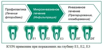 Лікування карієсу без бормашини - лазером, озоном і icon, зубів (лікування) Лікування карієсу без бормашини - лазером, озоном і icon, зубів