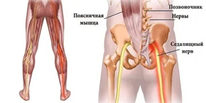 Лікування медикаментами ішіасу (запалення) сідничного нерва (сідничного) Лікування медикаментами ішіасу (запалення) сідничного нерва
