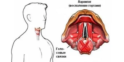 Ларингіт що це таке і заразний він чи ні