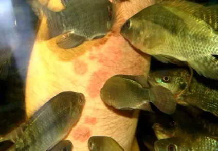 Лікування псоріазу рибками або fish - терапія (лікування) Лікування псоріазу рибками або fish - терапія