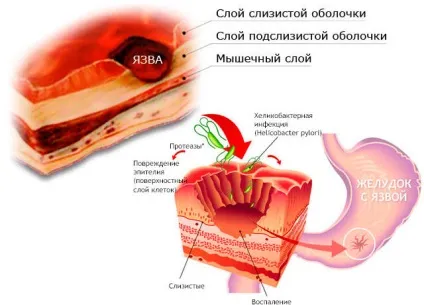 Лікування медом кишечника і шлунка (чайну ложку меду) Лікування медом кишечника і шлунка