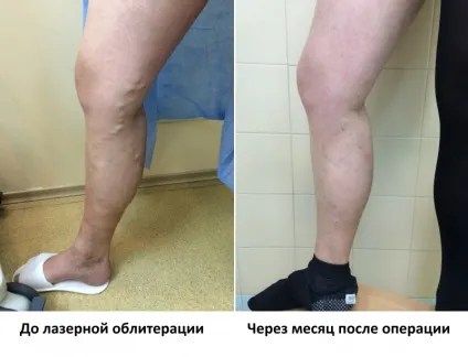 Лікування варикозного розширення вен на ногах в москві, лікування варикозної хвороби вен за доступною (ногах) Лікування варикозного розширення вен на ногах в москві, лікування варикозної хвороби вен за доступною