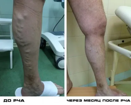Лікування варикозного розширення вен на ногах в москві, лікування варикозної хвороби вен за доступною (ногах) Лікування варикозного розширення вен на ногах в москві, лікування варикозної хвороби вен за доступною