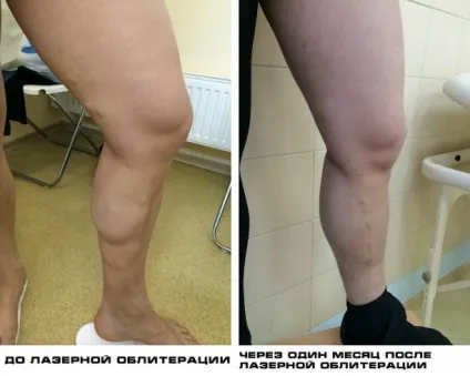 Лікування варикозного розширення вен на ногах в москві, лікування варикозної хвороби вен за доступною (москві) Лікування варикозного розширення вен на ногах в москві, лікування варикозної хвороби вен за доступною