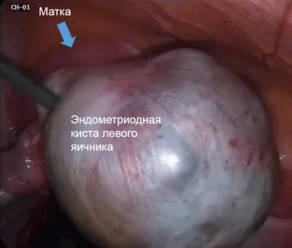 Лікування кісти яєчника медикаментозно показання і ефект (яєчника) Лікування кісти яєчника медикаментозно показання і ефект