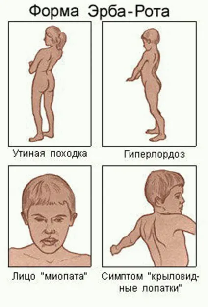 Лікування і симптоми м'язової дистрофії