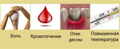 Лунка після видалення зуба як виглядає, чому з'являється білий наліт, гній і болю (суха лунка після видалення зуба) Лунка після видалення зуба як виглядає, чому з'являється білий наліт, гній і болю