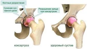 Методи лікування деформуючого артрозу тазостегнового суглоба 2 ступеня з фото і рекомендаціями (лікування) Методи лікування деформуючого артрозу тазостегнового суглоба 2 ступеня з фото і рекомендаціями