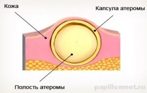 Нагноівшіеся атерома - лікування, ознаки та профілактика освіти (профілактика) Нагноівшіеся атерома - лікування, ознаки та профілактика освіти