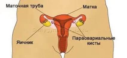 Не дозволяйте кісті ускладнити собі життя (більш пізньому терміні) Не дозволяйте кісті ускладнити собі життя