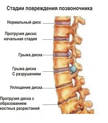 Нуга бест при захворюваннях хребта (бест) Нуга бест при захворюваннях хребта