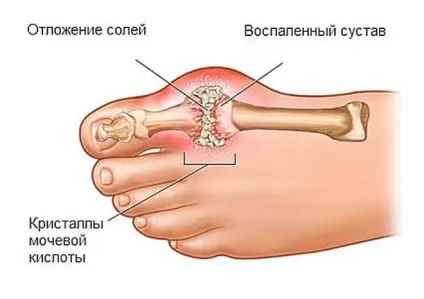 Знеболюючі при подагрі огляд засобів і методів (Курс лікування становить) Знеболюючі при подагрі огляд засобів і методів