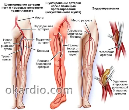 Облітеруючий атеросклероз судин нижніх кінцівок симптоми і лікування (атеросклероз) Облітеруючий атеросклероз судин нижніх кінцівок симптоми і лікування