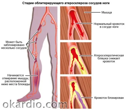Облітеруючий атеросклероз судин нижніх кінцівок симптоми і лікування (судин) Облітеруючий атеросклероз судин нижніх кінцівок симптоми і лікування