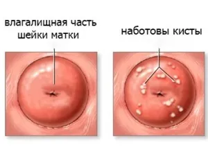 Про що говорить шишка в піхву (шишка) Про що говорить шишка в піхву