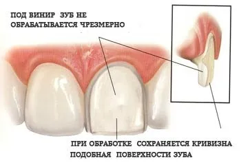 Облицювання зубів під вініри - 5 кращих методів препарування (препарування) Облицювання зубів під вініри - 5 кращих методів препарування