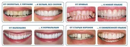 Облицювання зубів під вініри - 5 кращих методів препарування (вініри) Облицювання зубів під вініри - 5 кращих методів препарування