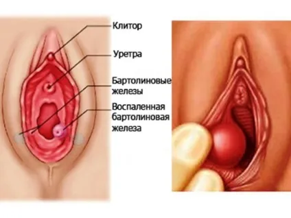 Про що говорить шишка в піхву (шишка) Про що говорить шишка в піхву