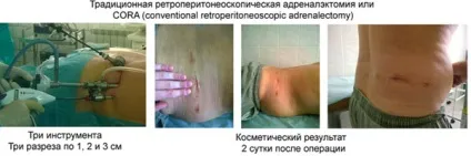 Операція з видалення аденоми наднирників - кандидат медичних наук макарьін виктор алексеевич (пухлина надниркових залоз симптоми лікування операція з видалення аденоми наднирників) Операція з видалення аденоми наднирників - кандидат медичних наук макарьін виктор алексеевич