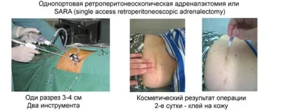 Операція з видалення аденоми наднирників - кандидат медичних наук макарьін виктор алексеевич (кандидат) Операція з видалення аденоми наднирників - кандидат медичних наук макарьін виктор алексеевич