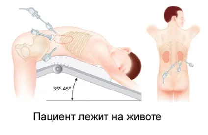 Операція з видалення аденоми наднирників - кандидат медичних наук макарьін виктор алексеевич (наднирників) Операція з видалення аденоми наднирників - кандидат медичних наук макарьін виктор алексеевич
