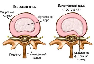 Ортопедична подушка з магнітами - користь і шкода (користь) Ортопедична подушка з магнітами - користь і шкода