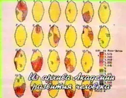 Дослідження мозку, томографія