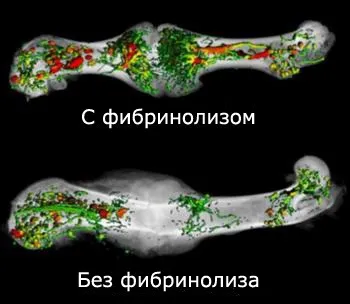 Дослідження виявило, що переломи кісток зростаються так, як ми думали (переломи) Дослідження виявило, що переломи кісток зростаються так, як ми думали