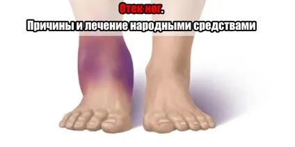 набряк ніг