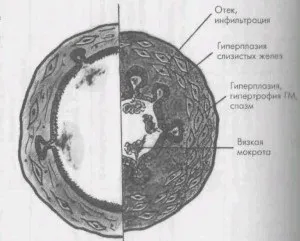 Перші ознаки бронхіальної астми (ознаки) Перші ознаки бронхіальної астми