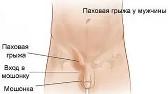 Пахова грижа у чоловіків фото - відповіді і поради (грижа) Пахова грижа у чоловіків фото - відповіді і поради