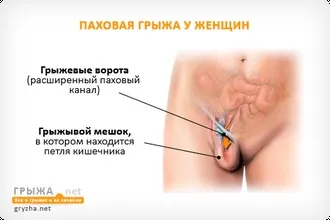 Пахова грижа у чоловіків фото - відповіді і поради (грижа) Пахова грижа у чоловіків фото - відповіді і поради