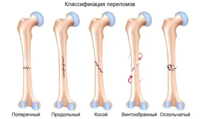 Перелом кісток поняття, види, симптоми, лікування (поняття) Перелом кісток поняття, види, симптоми, лікування