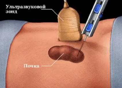 Парапельвікальная кіста нирки діагностика і лікування (лікування) Парапельвікальная кіста нирки діагностика і лікування