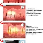 Підготовка до лазерної епіляції що потрібно знати і робити (знати) Підготовка до лазерної епіляції що потрібно знати і робити